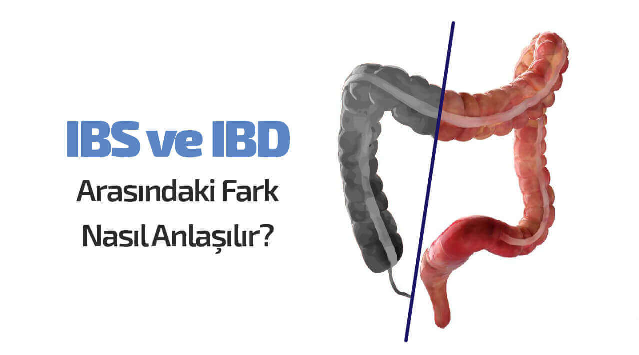 İrritabl Bağırsak Sendromu (IBS) ve İnflamatuar Bağırsak Hastalığı (IBD) Arasındaki Farklar Nelerdir?