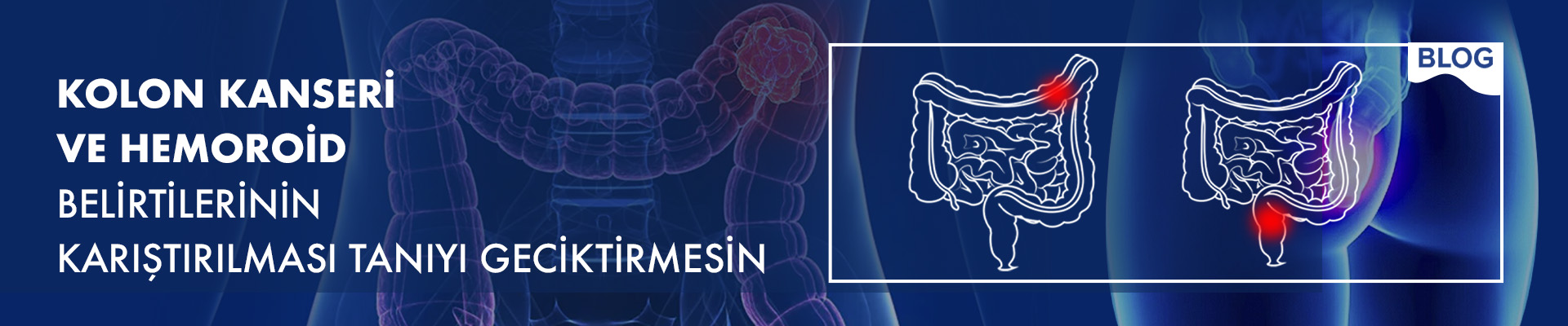 Kolon Kanseri ve Hemoroid Belirtilerinin Karıştırılması Tanıyı Geciktirmesin