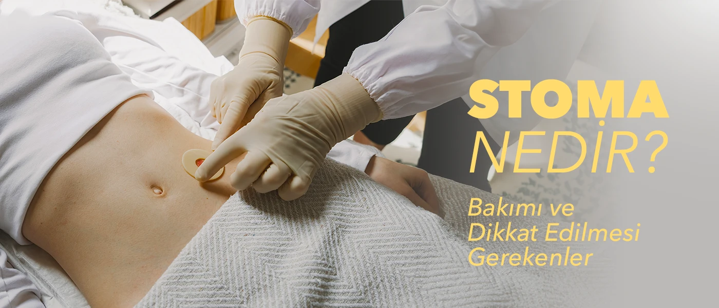 Stoma Nedir? Kolostomi, İleostomi ve Ürostomi Farkı